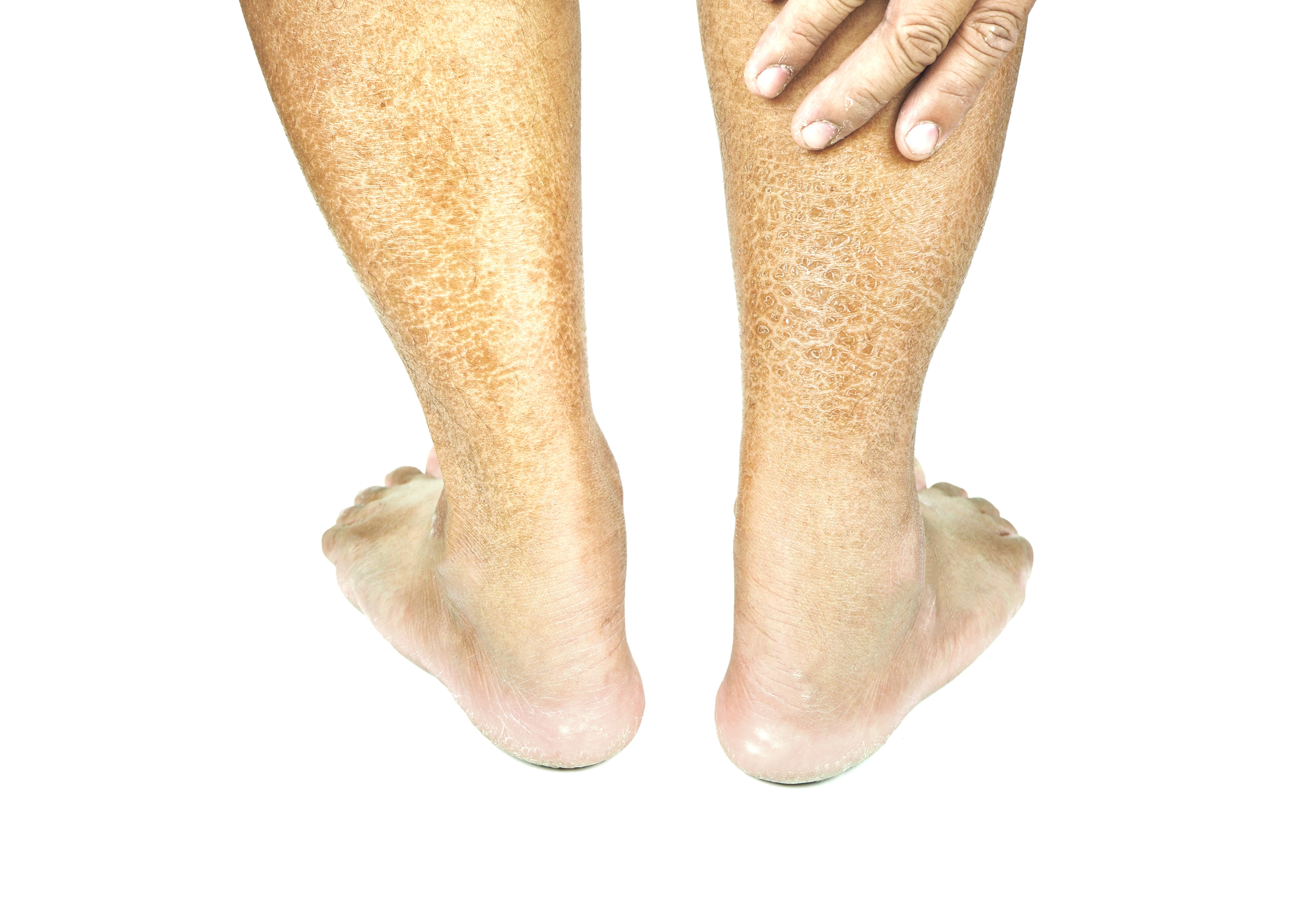 Close-up of a person's legs with flaky skin on a white background