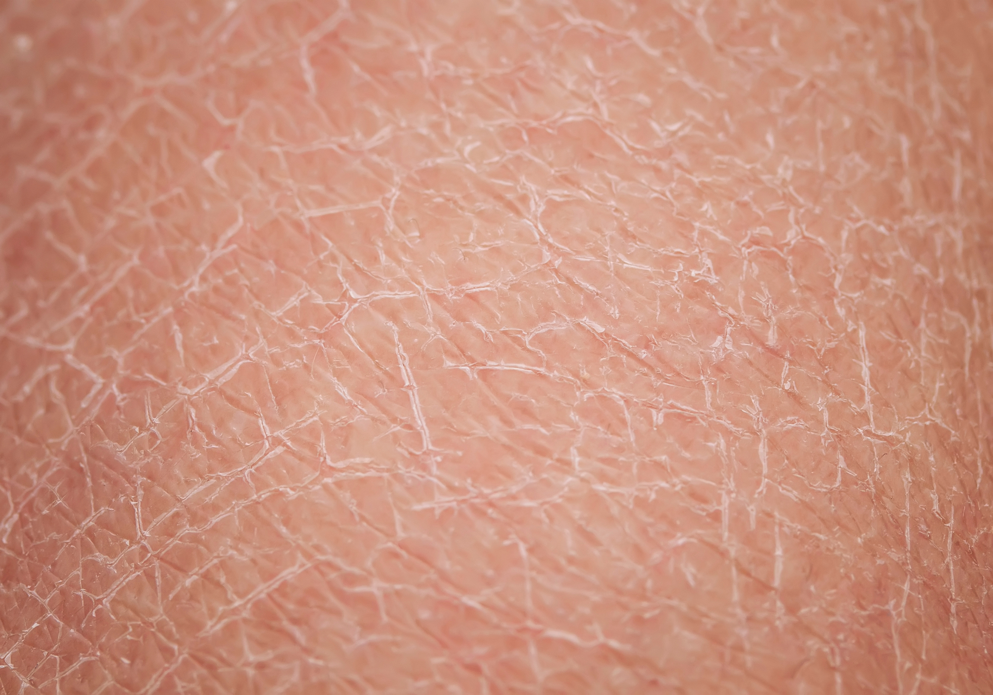Close-up of human skin texture that's dry and flaky