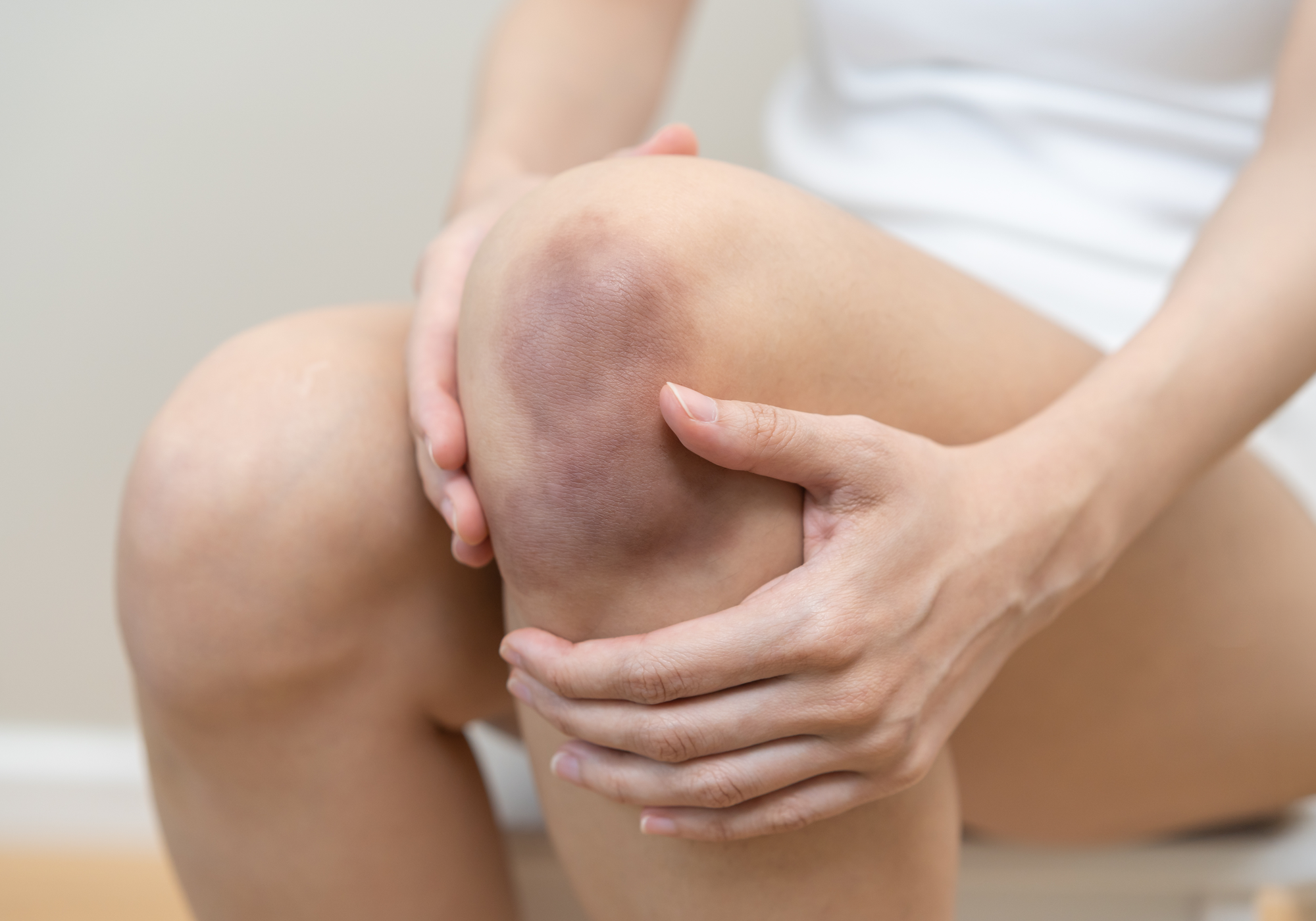 Person holding a knee with visible bruising on a plain background