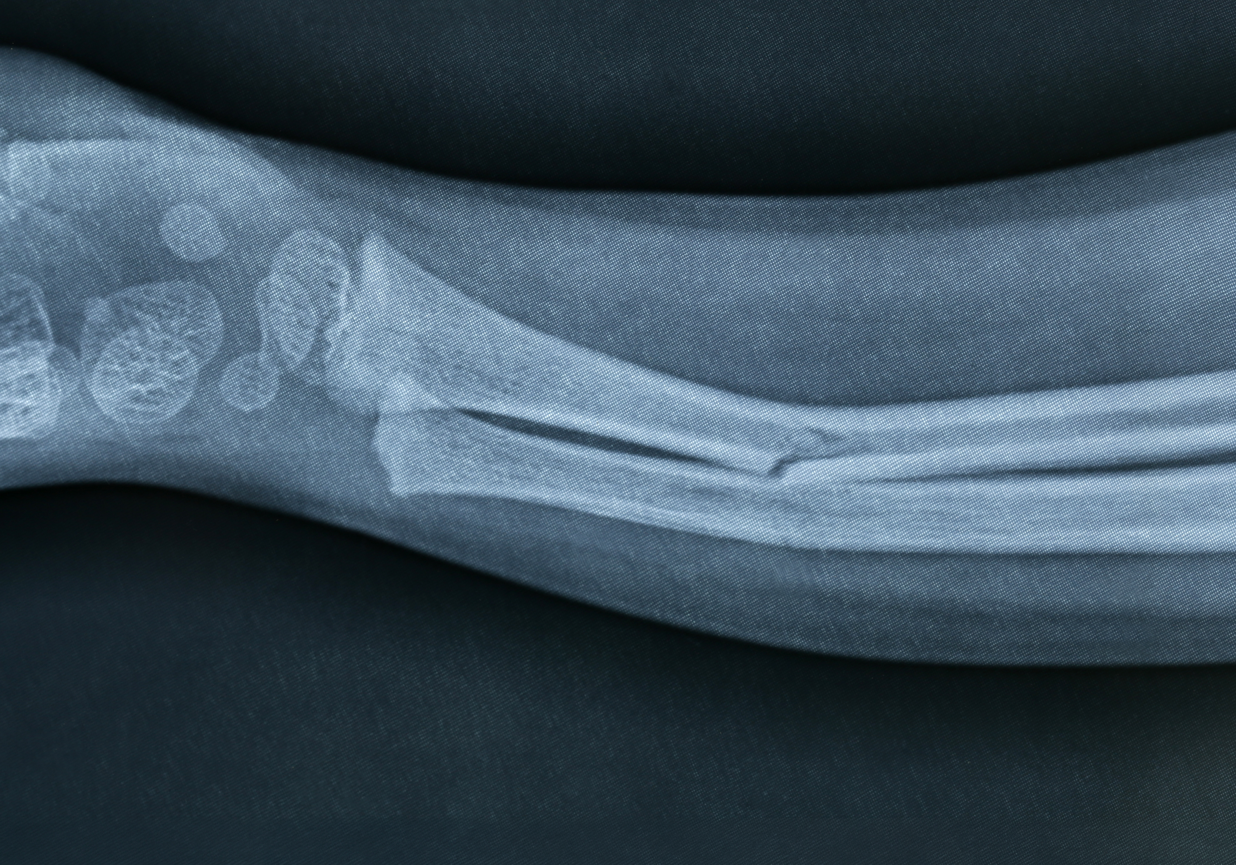 X-ray of a fractured bone