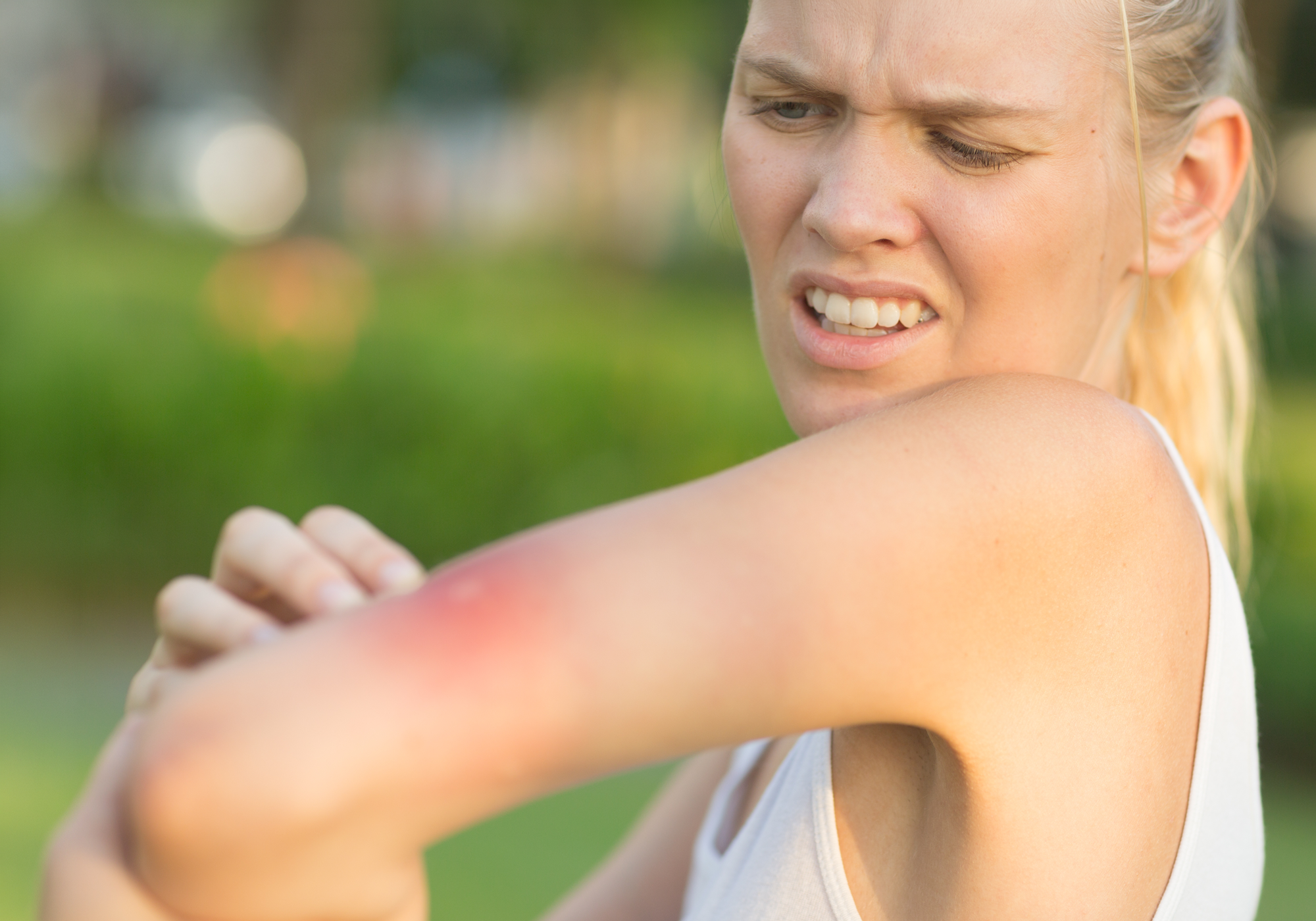 Woman with a painful red bug bite outdoors