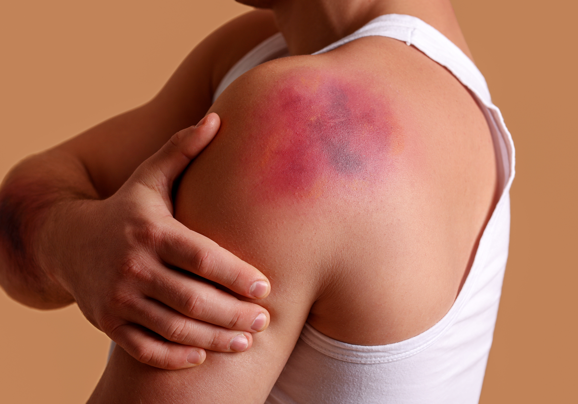 Person with a large bruise on their shoulder against an orange brown background